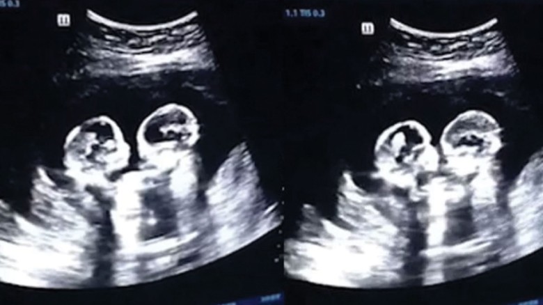 আলট্রাসনোগ্রামে মায়ের গর্ভে যমজ কন্যাশিশুর মারামারি!